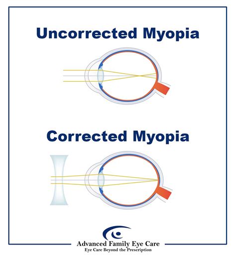how can myopia be corrected.